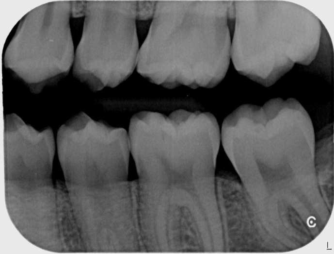 Bitewing Bilateral