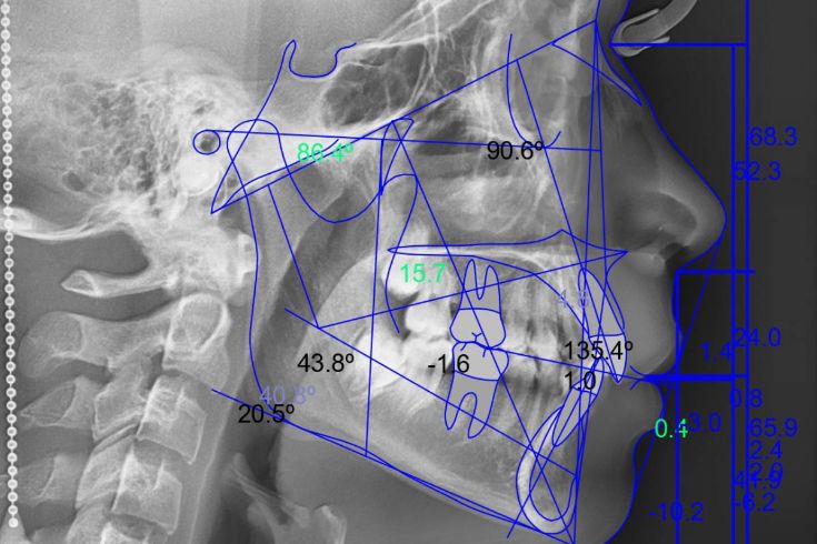 Análisis Cefalométrico