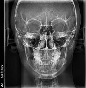 Telerradiografía Frontal