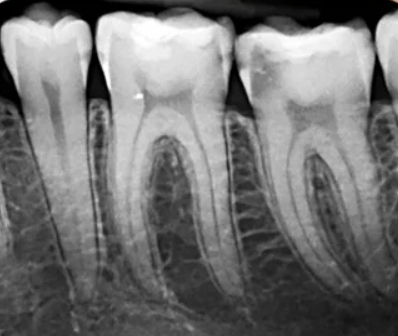 Periapical